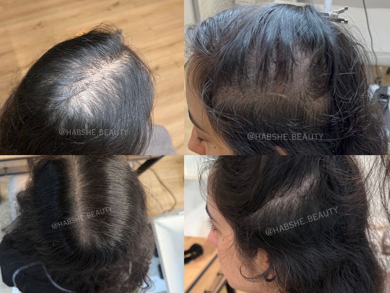 Vorher-Nachher: Haare, Mehr Dichte am Oberkopf